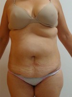 Abdominoplastia