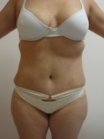 Abdominoplastia