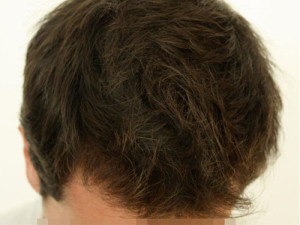 Alopecia Case 3476 After Photo Alopecia