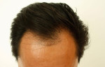 Alopecia