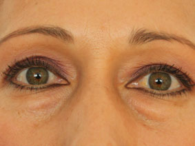 Blefaroplastia Case 3426 Before Photo Blefaroplastia