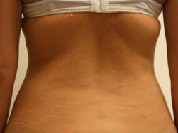 Carboxiterapia Case 3569 After Photo Carboxiterapia