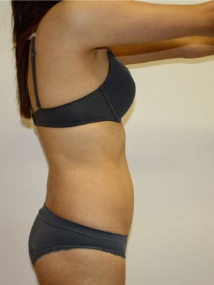 Liposucción Case 3504 After Photo Liposucción