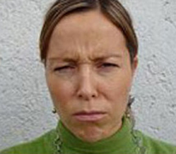 Toxina Botulínica Case 3454 Before Photo Toxina Botulínica