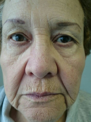 HIFU Case 4154 Before Photo HIFU