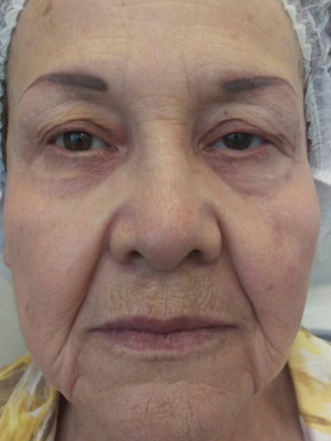 HIFU Case 4154 After Photo HIFU
