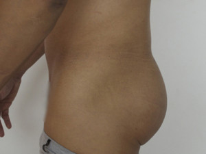 Implantes de Gluteo Case 4196 After Photo Implantes de Gluteo