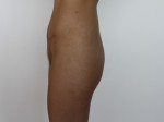 Implantes de Gluteo