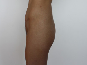 Implantes de Gluteo Case 4177 Before Photo Implantes de Gluteo