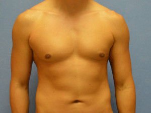 Aumento de Pectoral Case 4179 Before Photo Aumento de Pectoral