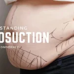 Understanding Liposuction 8 Liposuction
