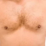 Male Breast Reduction In Mexico: Gynecomastia Surgery In Puebla 3 Male Breast Reduction