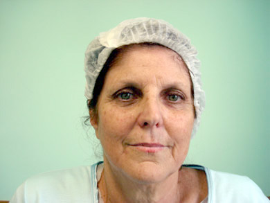 Face Lifting Before & After Face Lifting Results Mexico