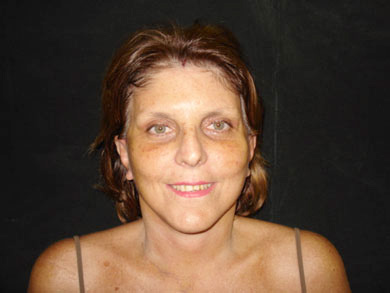 Face Lifting Before & After Face Lifting Results Mexico