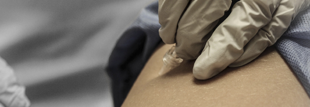 Carboxiterapia 5