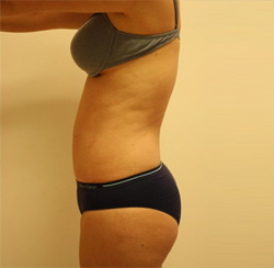 Lipo D